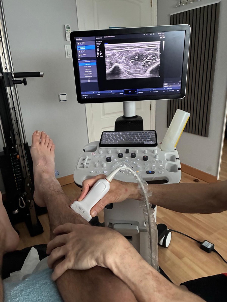 Ecografía musculoesquelética realizada en Fisioterapia 3 Olivos